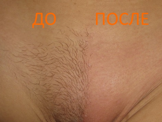 До и после процедуры биоэпиляция бикини