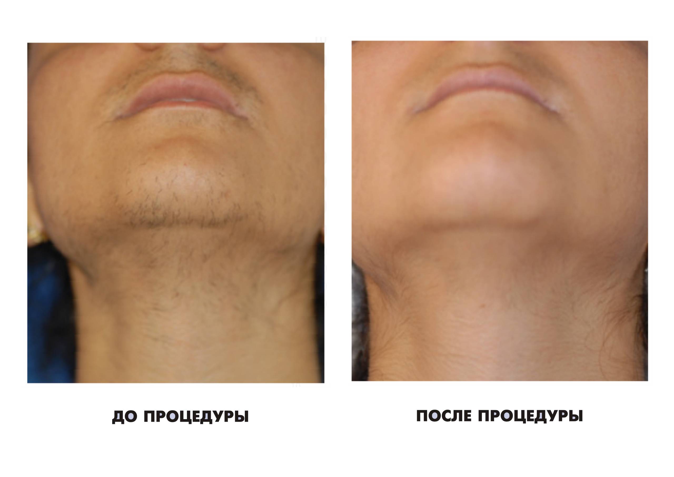 Эпиляция лазером Эпиляция