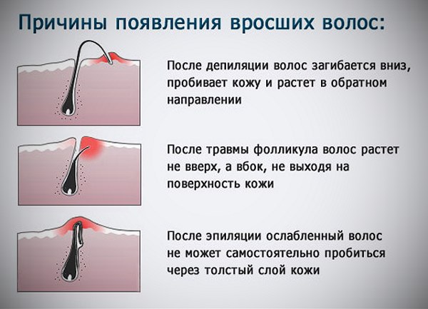 Откуда беруться вросшие волосы как избавиться от вросших волос