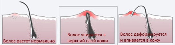 Схема роста вросших волос удаление вросших волос