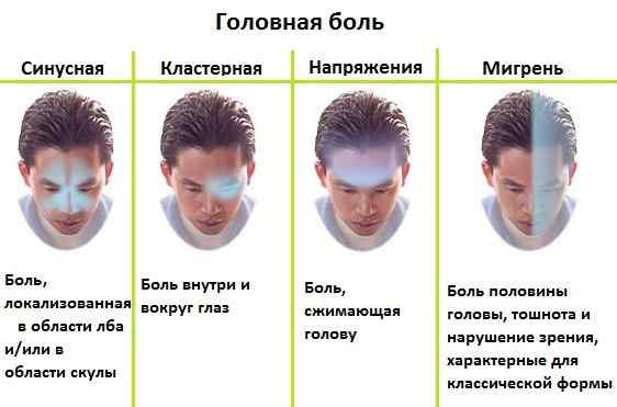 Виды головной боли