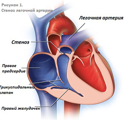 стеноз сердца