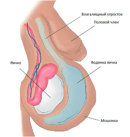 водянка схема