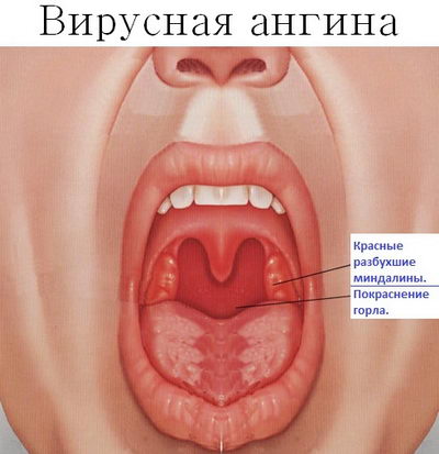 Симптомы вирусной ангины Симптомы вирусной ангины