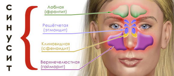 Синусит: классификация Синусит: классификация